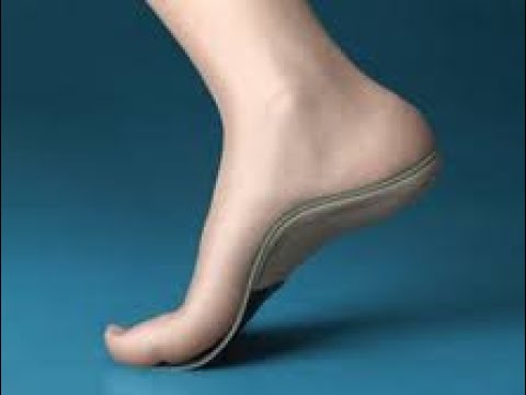 Custom made orthotics for plantar fasciitis 