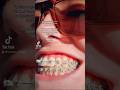 Flared teeth with braces! 😭Getting IPR! No extractions #braces#bracesupdate#teethflaring#ipr#ortho