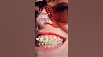Flared teeth with braces! 😭Getting IPR! No extractions #braces#bracesupdate#teethflaring#ipr#ortho