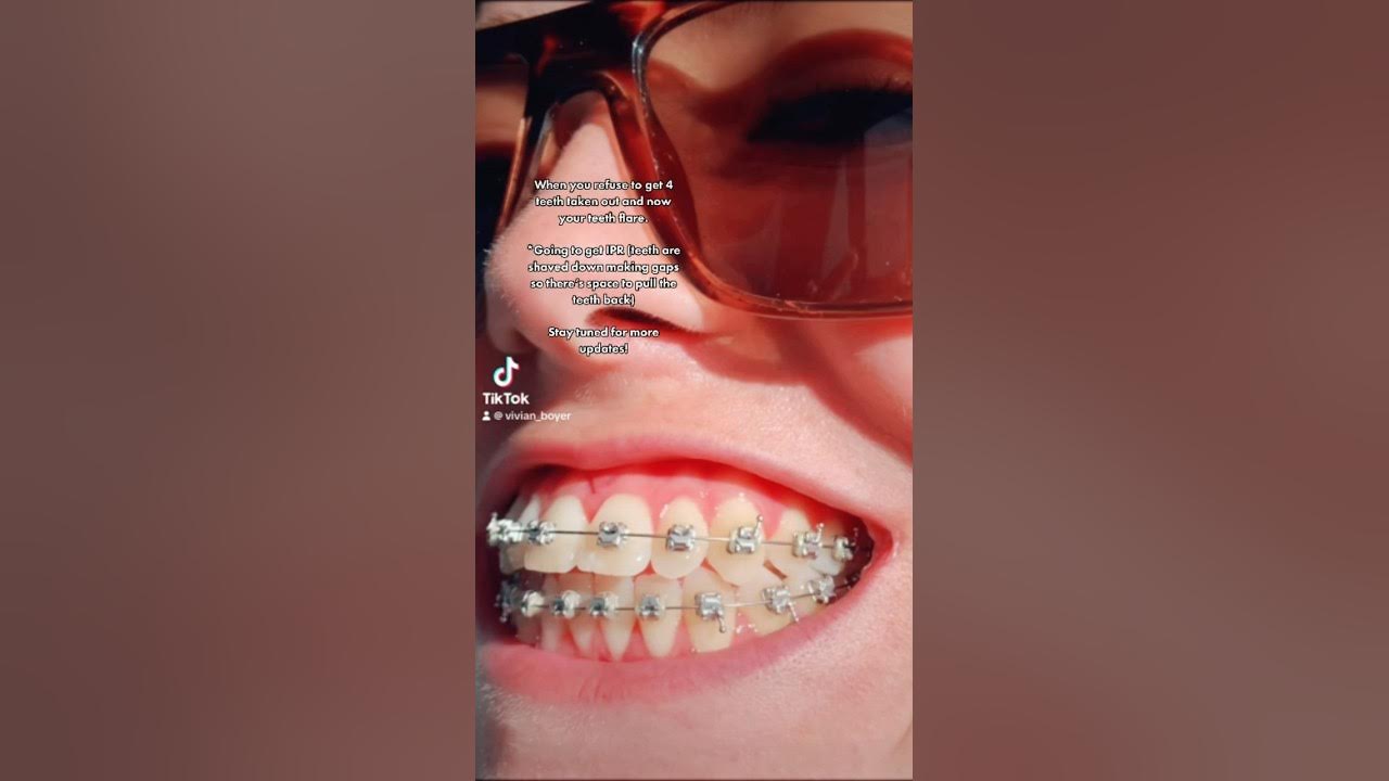 Flared teeth with braces! 😭Getting IPR! No extractions braces