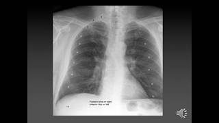 Assessing CXR inspiration (5/8)