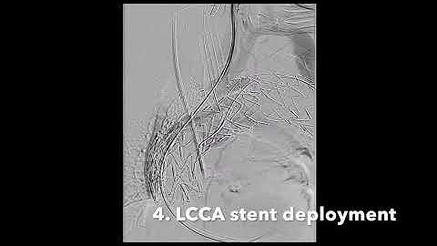 Total endovascular arch repair with a triple branch endograft