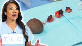 Dr Sandra Lee Removes Unusual Bumps From Patient | Dr Pimple Popper | UNCENSORED | 18+