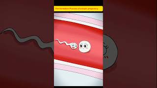 The Formation Process Of Ectopic Pregnancy