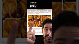 Uterine Anomalies Short