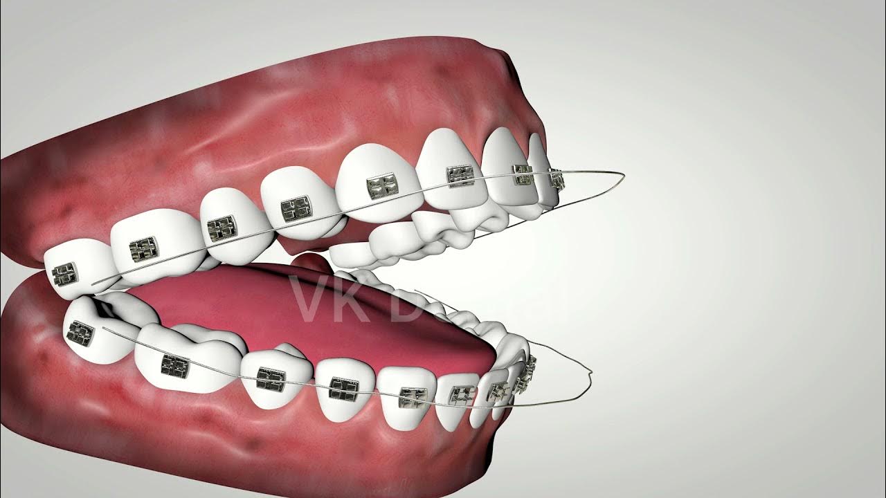 SETTLING ELASTICS ANIMATION FOR BRACES VK DENTAL CLINIC LINGAMPALLI