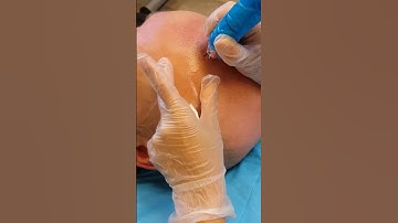 Scalp Micropigmentation Baldness SMP by El Truchan @ Perfect Definition