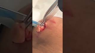Short Ock Cyst