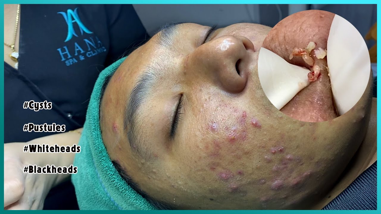 Big Cystic Acne Blackheads Extraction Blackheads & Milia, Whiteheads Removal Pimple Popping