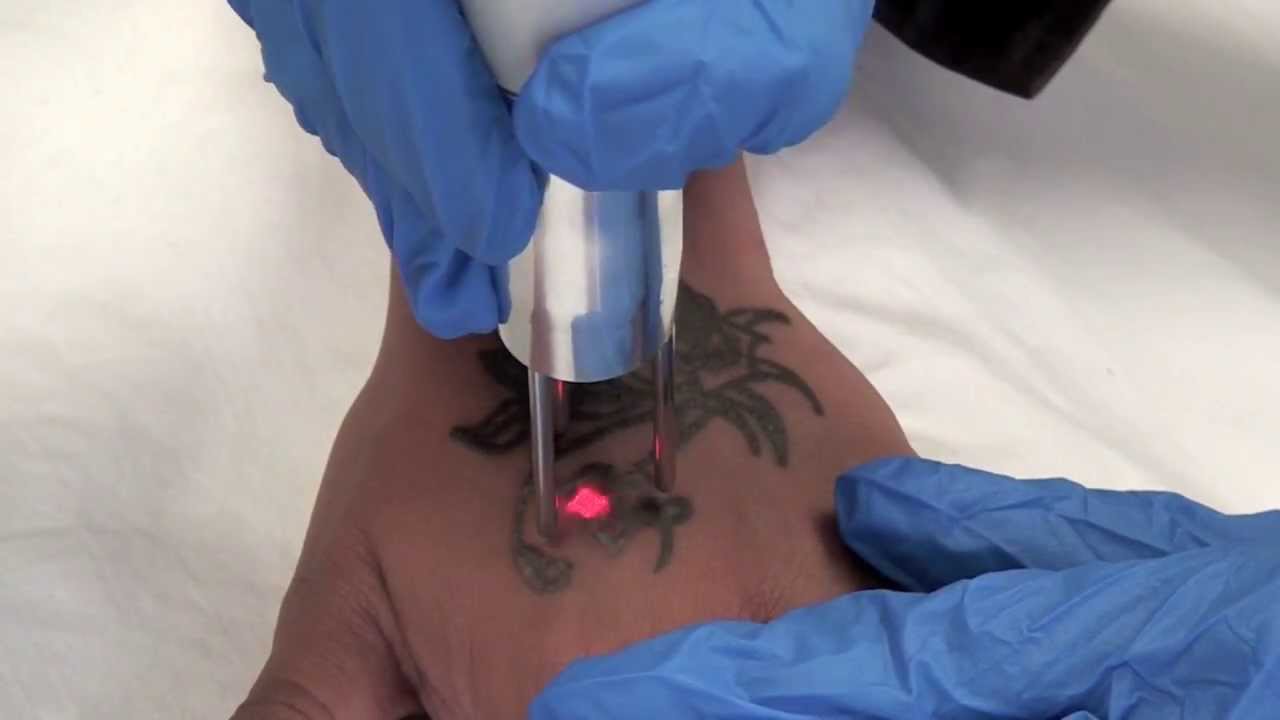 Q-Switched Nd:YAG Tattoo Removal Laser -- The Astanza ...