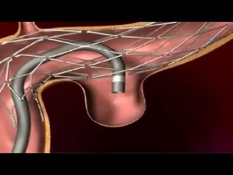 Endovascular Coiling For Brain Aneurysm