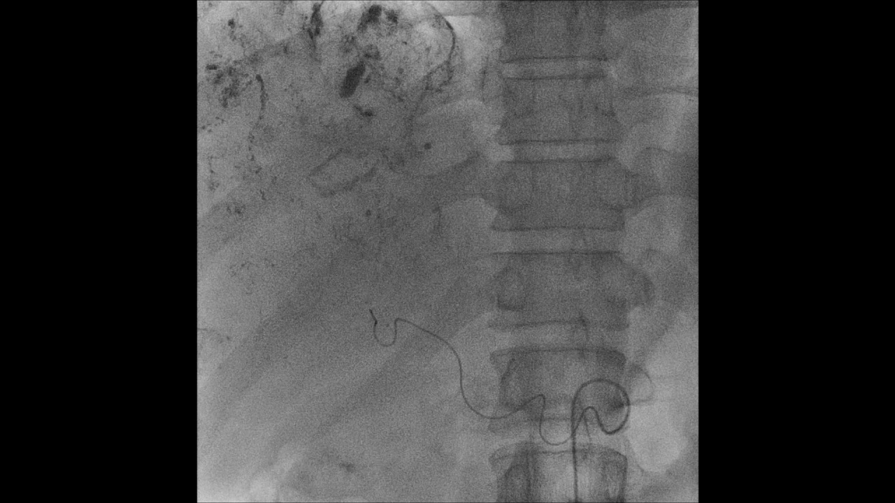 figure 4 lipiodol leakage WMV