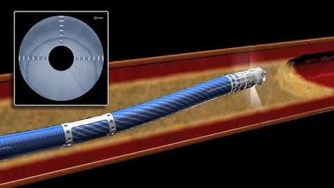 Ocelot Animation - Crossing a Peripheral Artery Disease CTO