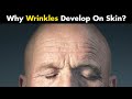 What Causes Wrinkles On Skin? | Wrinkles - Symptoms, Causes And Treatment (Urdu/Hindi)