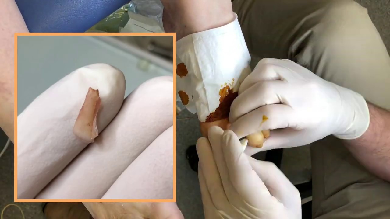 Nail Surgery - Ingrown Toenail Clinics