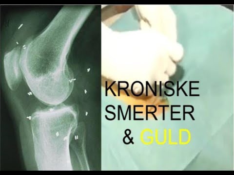 Video: Smerter I Fingerled Når Der Trykkes På: Årsager Og Behandling