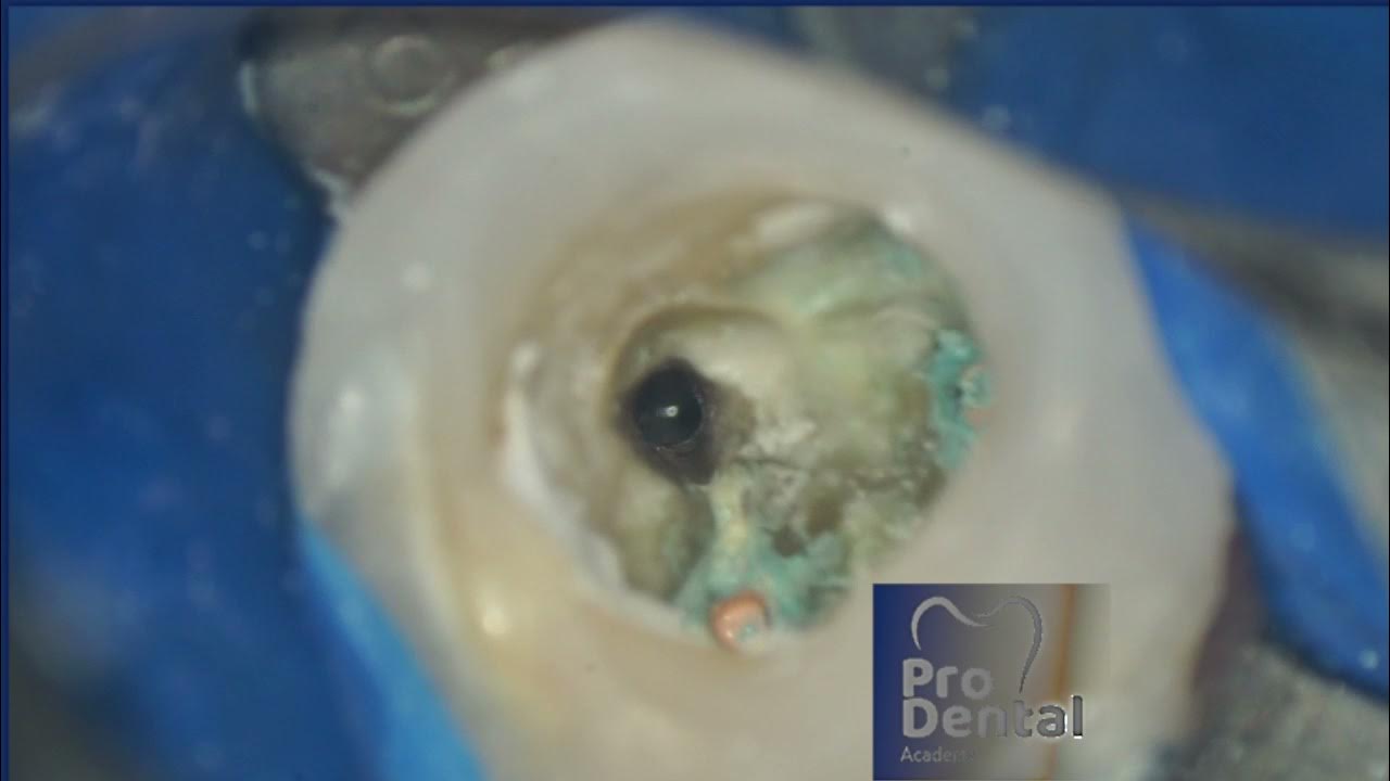weeping (pulsating )canals and microsuction YouTube