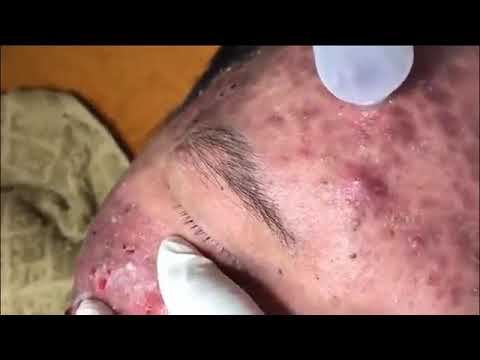 How To Pop Giant Pimples (Severe Cystic Acne)