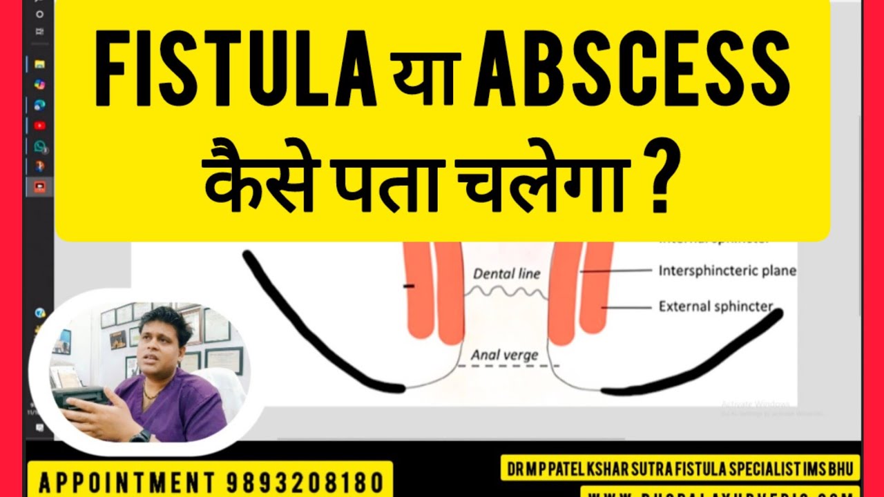 FISTULA है या ABSCESS कैसे पता चलेगा ?