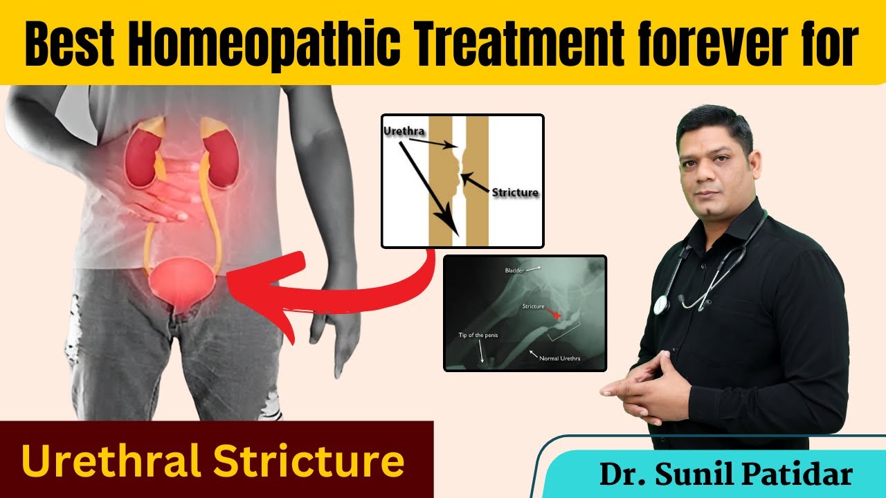 Best Homeopathic Treatment Forever for Urethral Stricture | Sunil Patidar 