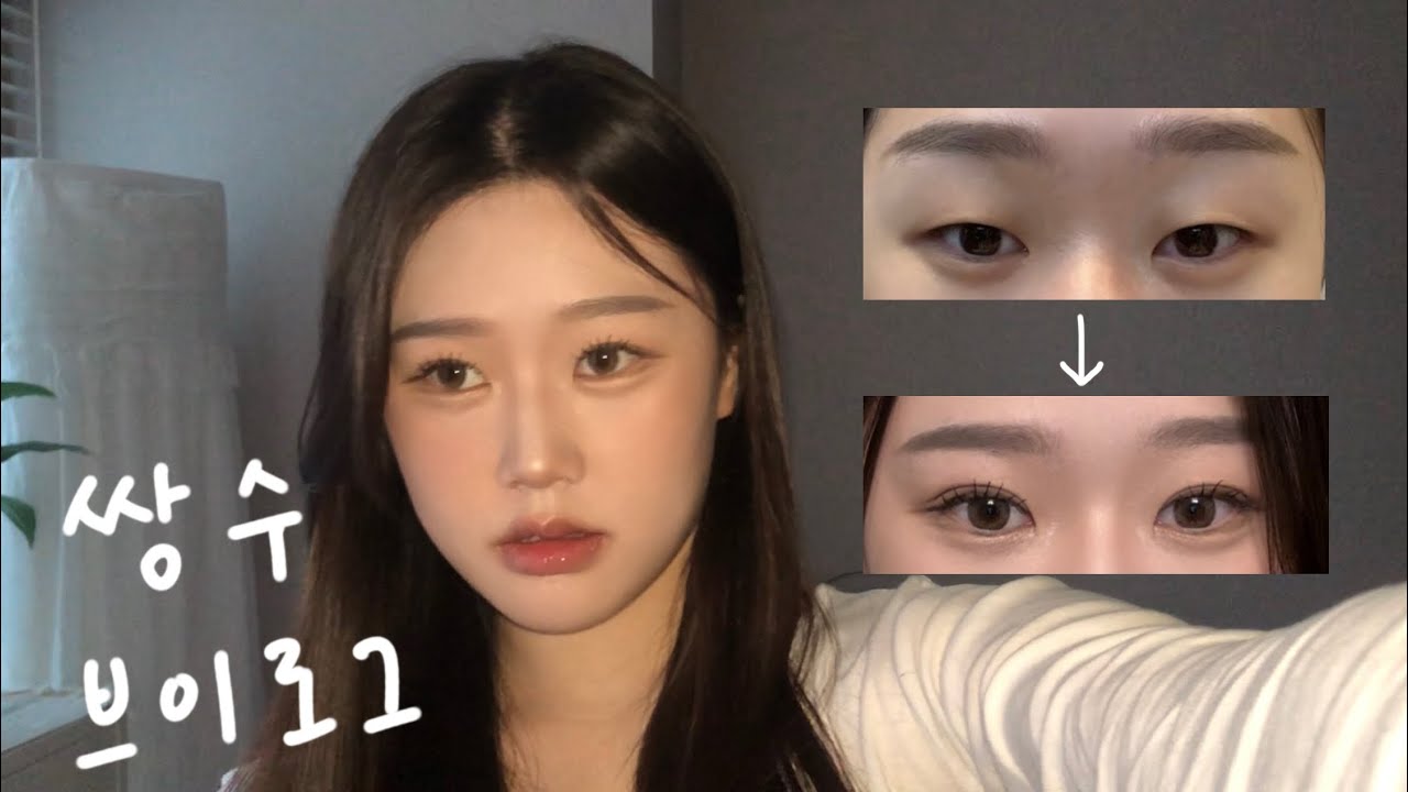 고3 쌍수 한달차 브이로그 절개 인아웃