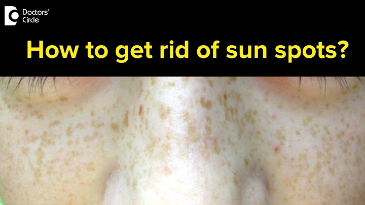 Home remedies for sun spots on face