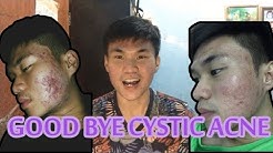 JERAWAT BATU selamat tinggal (For sensitive Skin) my cystic acne story - Durasi: 11.26. 