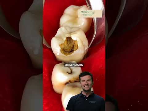 Video: 12 Möglichkeiten, einen losen Zahn zu Hause zu ziehen