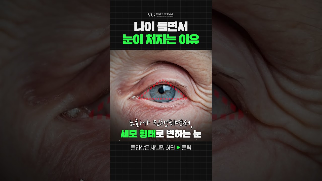 [베리굿성형외과의원] Nguyên nhân mắt chảy xệ do lão hóa #mắt_chảy_xệ #lão_hóa #nâng_cơ