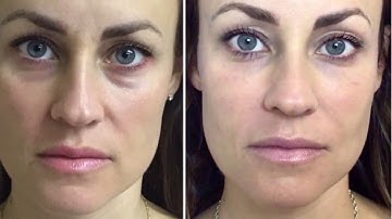 Dermal Filler Under Eyes~ Tear Trough