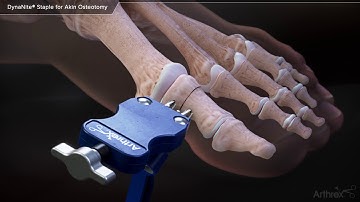 DynaNite® Staple for Akin Osteotomy