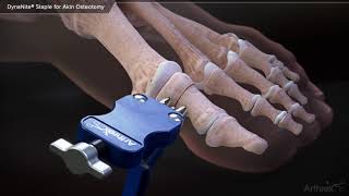 DynaNite® Staple for Akin Osteotomy