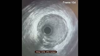 Orbital Atherectomy (OA) on a severely calcified, stenotic Ostial LCx artery