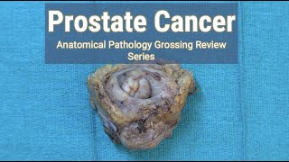 Prostate Cancer | Anatomical Pathology Grossing Review Series