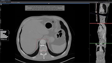 Deep Learning Inpainting of Aortic Dissections with Studierfenster