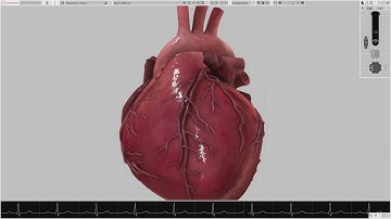 Left Atrial Appendage Occlusion Devices - Hooked LAA with watchman