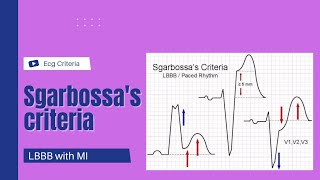 Sgarbossa Criteria || LBBB MI