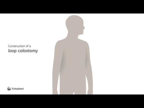 Video: Wat is een omleidingslus-colostoma?
