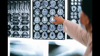 Dysembryoplastic Neuroepithelial Tumour: The Benign Brain Tumour That Disrupts Young Lives