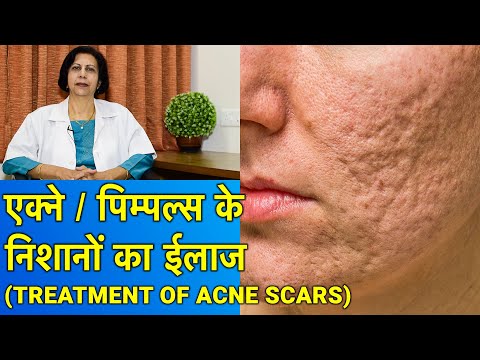 एक्ने / पिम्पल्स के गड्ढों का ईलाज || Acne Scar Treatment