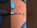 #PimplePixy #AcneClean #SatisfyingExtraction #PimplePopping #skincareasmr