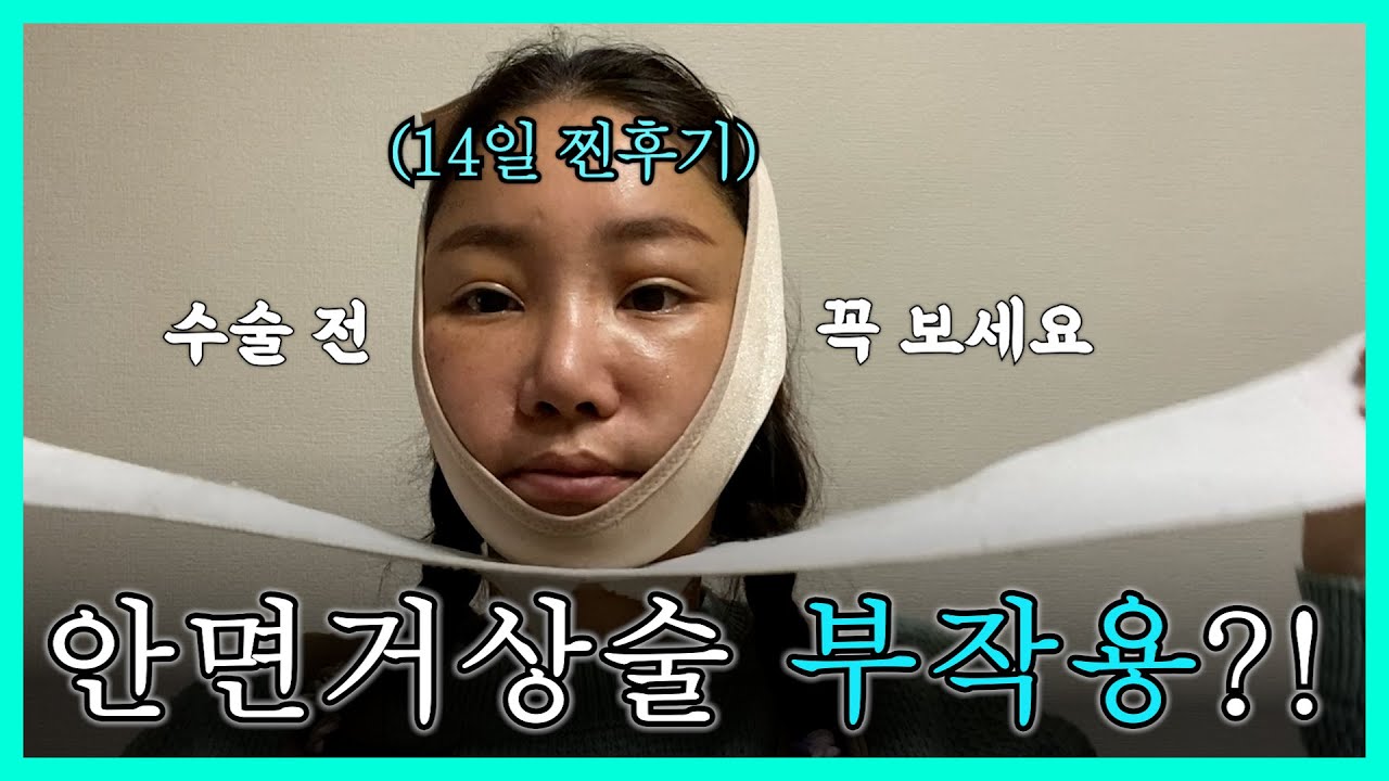 안면거상술 후기 8~14일차 찐경험담 (부작용, 비용, 붓기,통증 솔직심경)