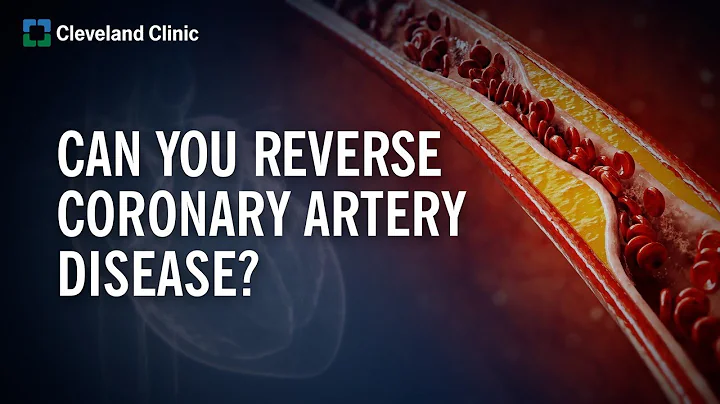 Can You Reverse Coronary Artery Disease? - DayDayNews