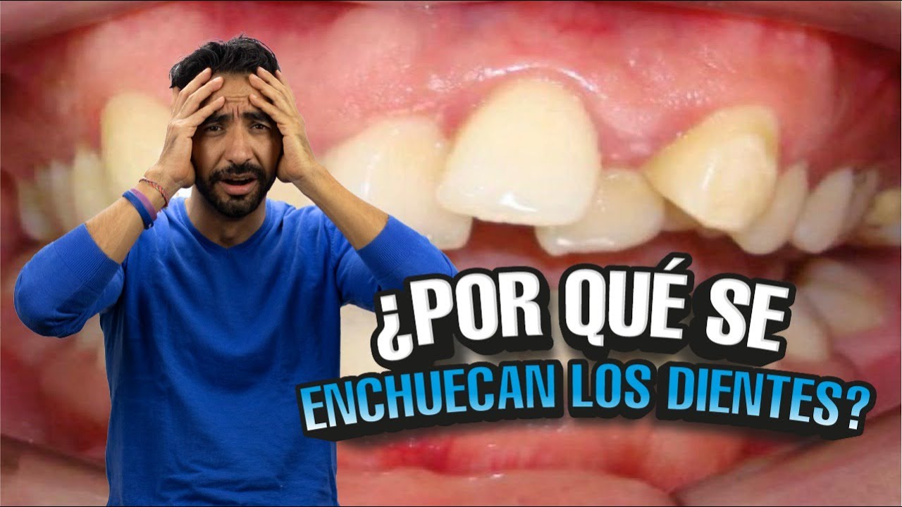 Por qué se enchuecan tus después de tener brackets I Tu Dentista de Confianza - YouTube
