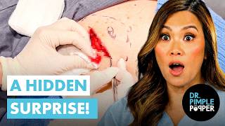 Cheryl's Lipoma Has A Hidden Surprise!