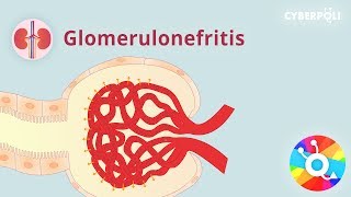 Wat Is Een Glomerulus En Wat Gebeurt Bij Glomerulonefritis?