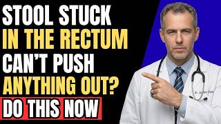 Stool STUCK In The RECTUM Here’s What To Do Immediately!