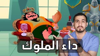 داء الملوك - النقرس