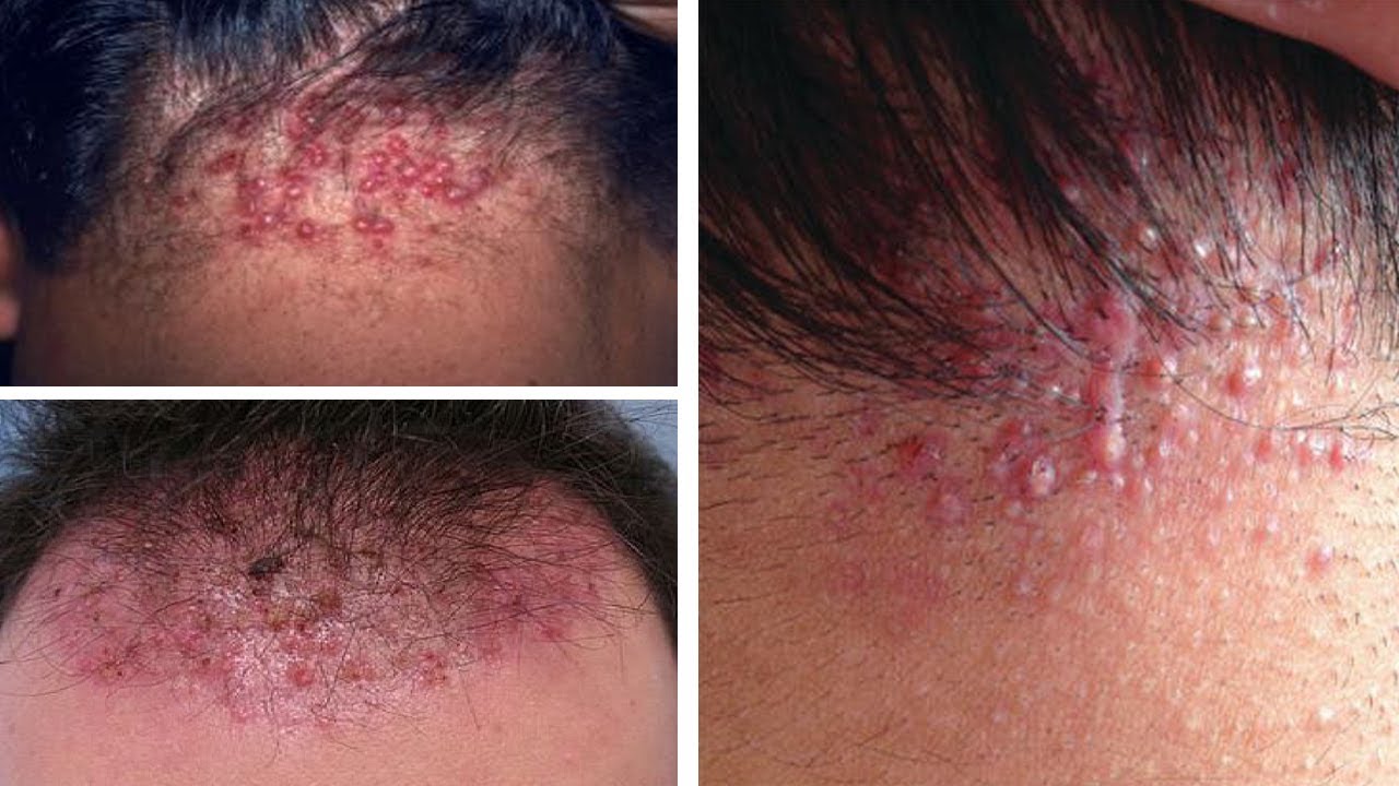 Folliculitis Scalp