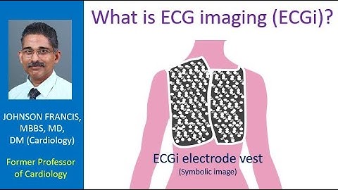 What is ECG imaging (ECGi)?